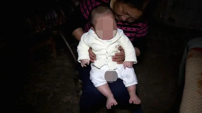 [Bintang] Terlahir 16 Jari, Bayi Ini Jalani Operasi untuk Menguranginya