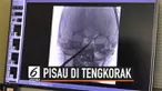 Dokter di Amerika Serikat berhasil mengeluarkan sebuah pisau yang menancap di tengkorak seorang anak.