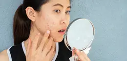 Ilustrasi perempuan dengan kulit wajah yang bermasalah. (depositphotos.com/Boysloso)