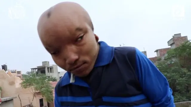 VIDEO: Pria Ini Dijuluki Alien Karena Miliki Kepala Besar