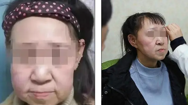 Operasi Plastik, Gadis dengan Penyakit Langka Menangis Haru Lihat Wajah Barunya