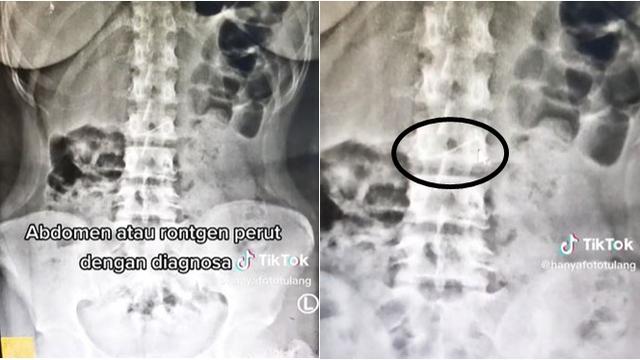 Tertancap di Usus, Wanita Ini Tak Sengaja Telan Jarum Pentul saat Pakai Hijab