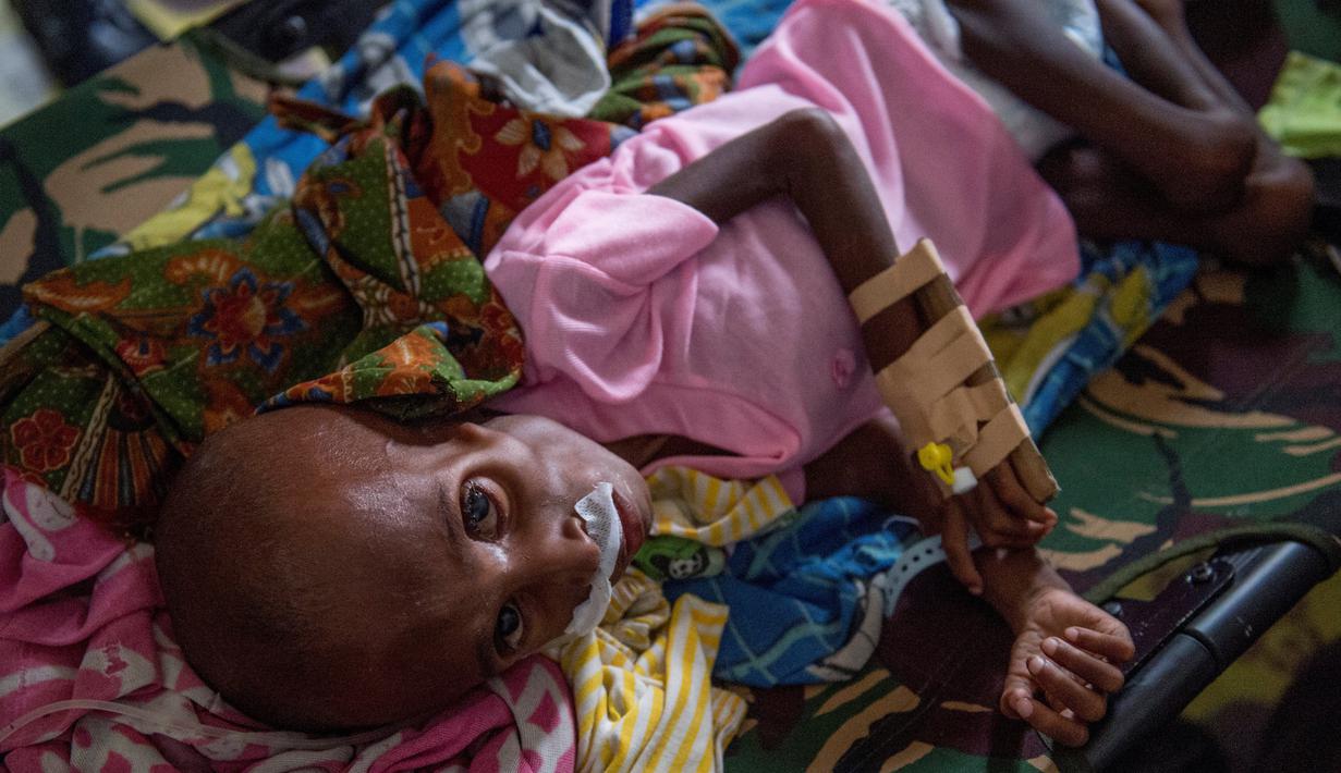 Seorang anak Papua yang menderita kekurangan gizi terbaring di tempat tidur rumah sakit untuk mendapat perawatan di Agats, Asmat, provinsi Papua Barat (26/1). (AFP/Bay Ismoyo)
