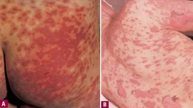Ilustrasi penyakit Stevens-Johnson Syndrome (SJS)