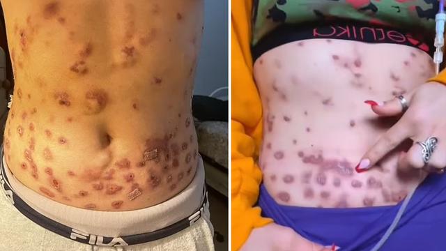 Tubuh Influencer Berakhir Digerogoti Penyakit Karena Suntikan Pembakar Lemak