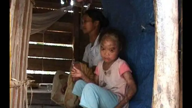 6 Manusia Bersisik yang Menghebohkan
