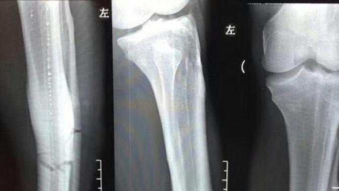 Hasil scan patah kaki Demba Ba. (AFP)