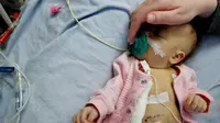 Bayi berusia tiga bulan Amy Joy Jones didiagnosis dengan  gastroschisis (Foto: Time)