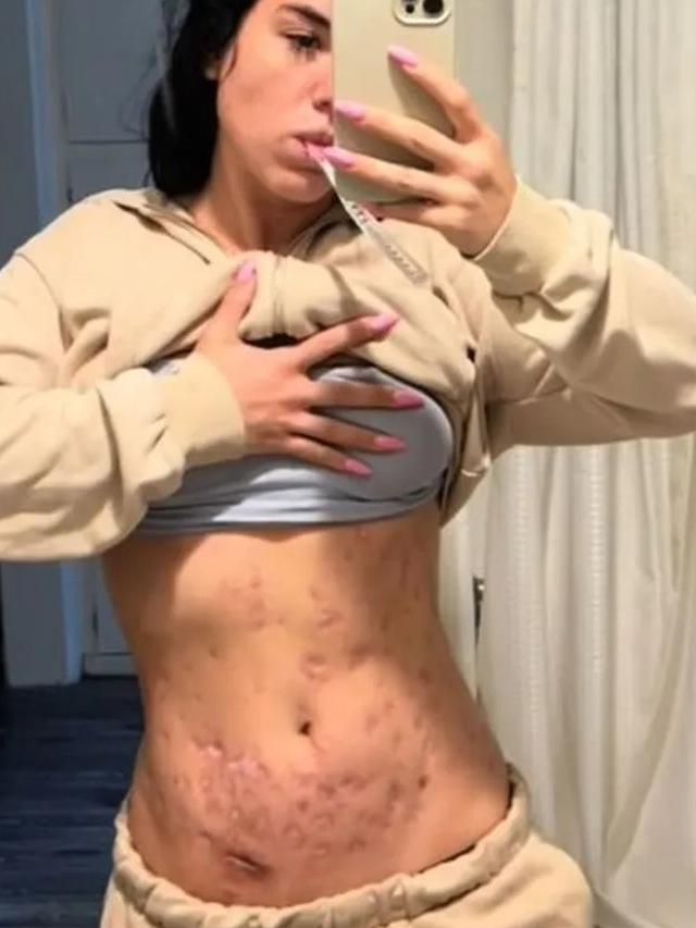 Tubuh Influencer Berakhir Digerogoti Penyakit Karena Suntikan Pembakar Lemak