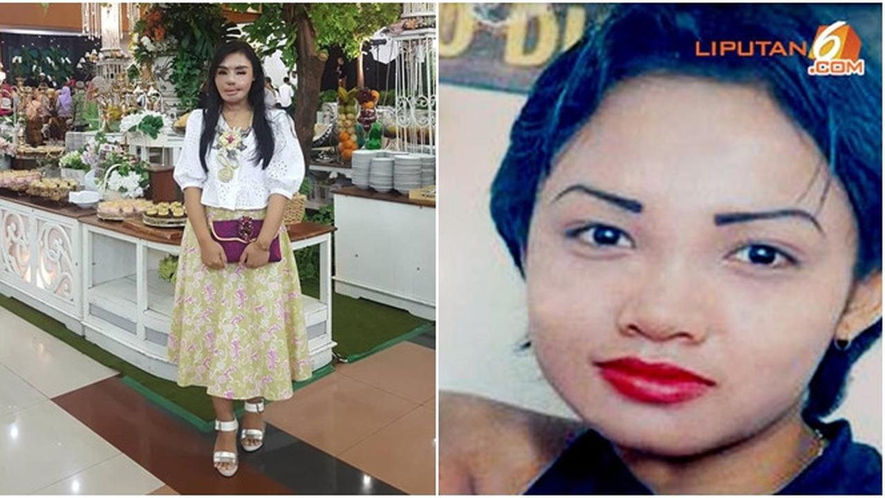 Potret Lisa 14 tahun yang lalu saat menjadi korban penyiraman air keras