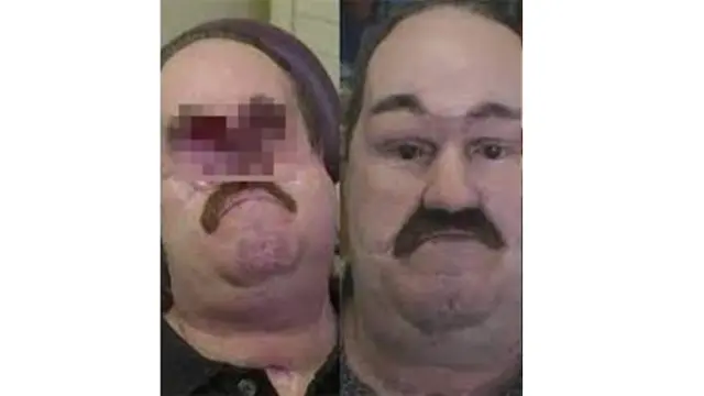Mata dan Hidung Terinfeksi Jamur, Kisah Pria Tanpa Wajah Ini Bikin Haru