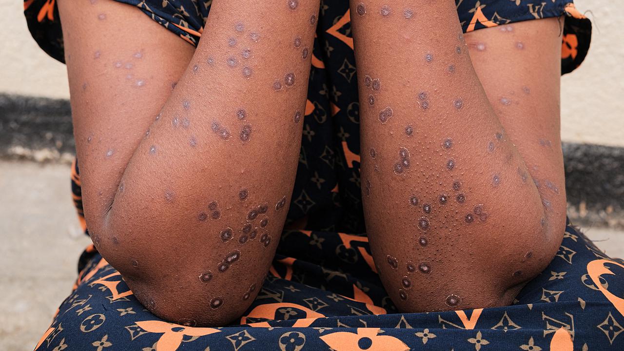 Burundi Mencatat 171 Kasus Mpox