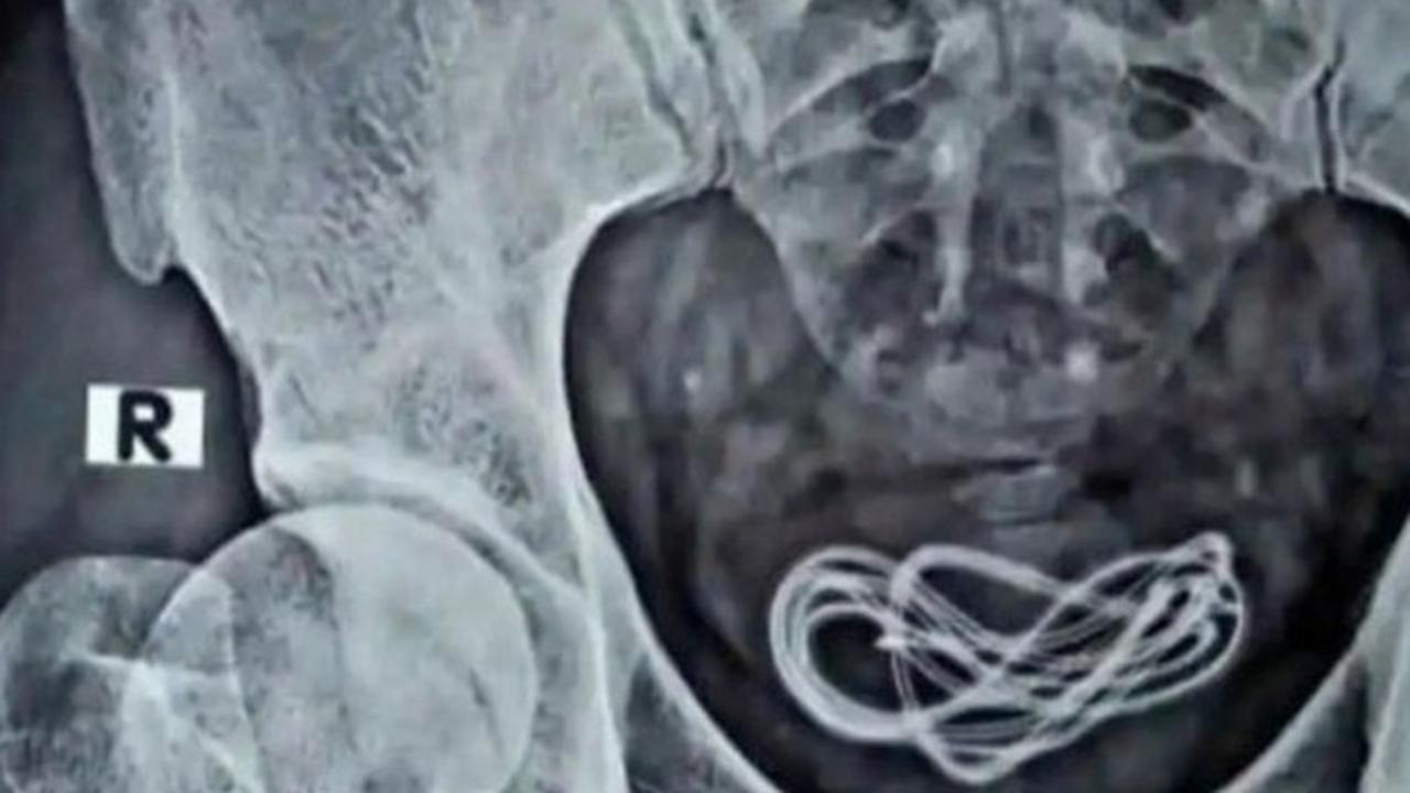 Kabel 60 Cm Ditemukan dalam Kandung Kemih Pria Ini, Buat Kepuasan Seksual?