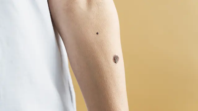 Apa Itu Keloid?