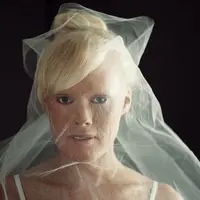 Sering dibully karena kulitnya bersisik, sekarang cewek ini jadi ratu kecantikan lho! (Foto: thecourierexpress.com)