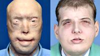 Seorang pemadam kebakaran tercatat sebagai manusia yang paling banyak menjalani operasi plastik pada wajahnya yang pernah terbakar.
