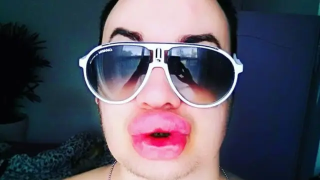 Pria Ini Filler Bibir Rp 65 Juta Demi Mirip Marilyn Monroe