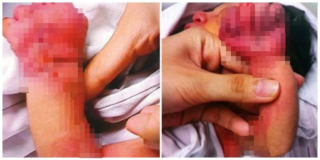 Bayi yang mengalami luka parah setelah digigit oleh ibunya sendiri. | Foto: copyright mirror.co.uk