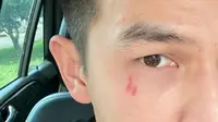 Foto Jonathan Frizzy dengan Bekas Luka Cakar Diungkap Benny Simanjuntak