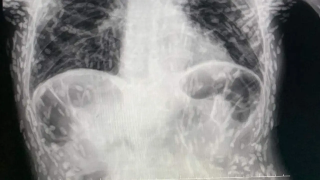 Sinar X-ray dari tubuh pria (Tangkapan layar dari website odditycentral.com)