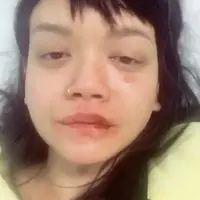 Dengan wajah yang masih babak belur akibat dipukul, Dylan Sada curhat soal kekerasan yang dialaminya. (Instagram)