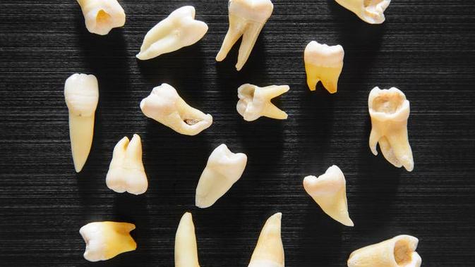 Gigi Berlubang Bisa Sebabkan Kematian