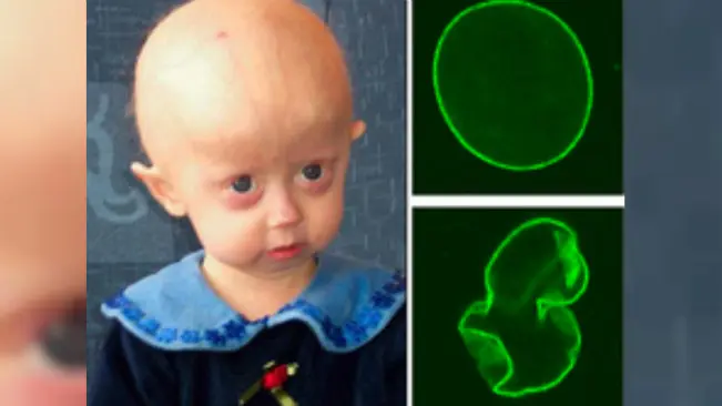 Hutchinson-Gilford Progeria Syndrome. (Sumber Wikimedia/P. Scaffidi, L. Gordon, T. Misteli)