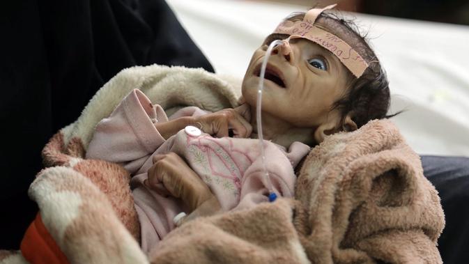 Menderita gizi buruk, bayi asal Yaman ini kurus kering bagaikan tengkorak hidup.