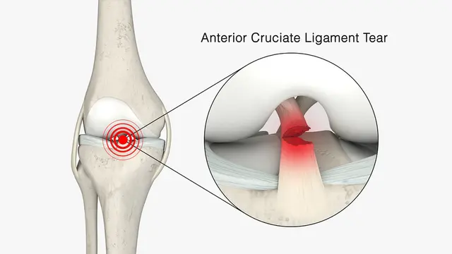 Cedera Acl Kenali Gejala Cara Mencegah Dan Cara Mengatasinya Health 9181