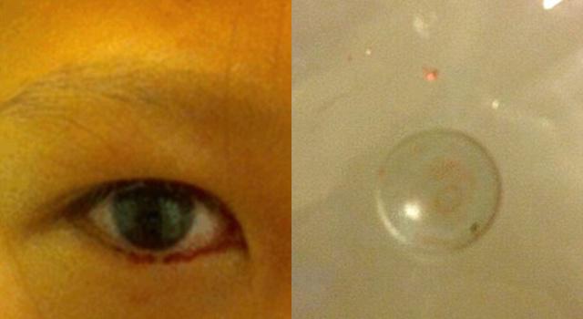 Gadis menangis darah dan ditemukan lensa kontak terjebak di matanya | Photo: Copyright dailymail.co.uk