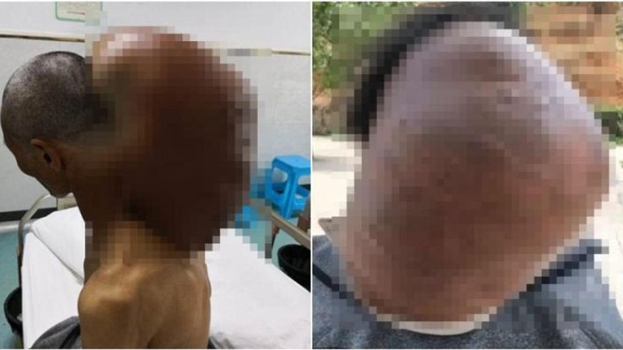 47 Tahun, Tumor 15 Kg Bersarang di Leher Belakang Pria Ini