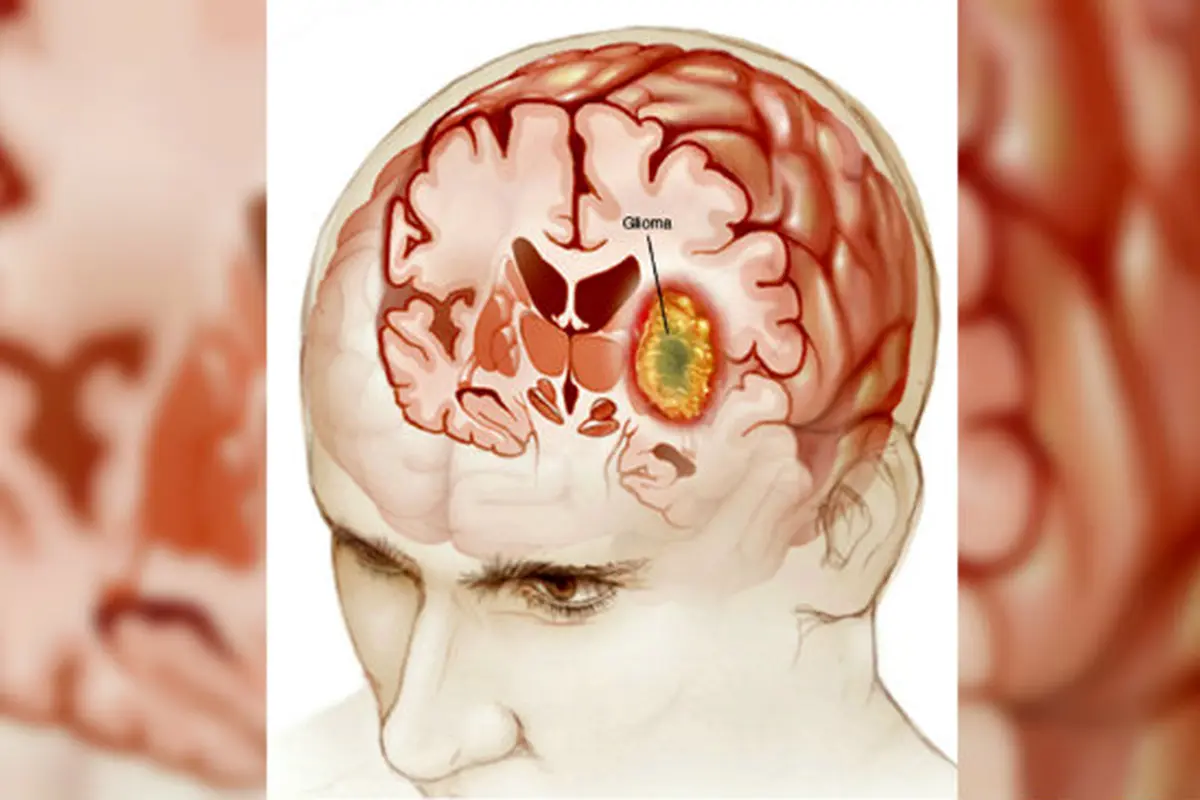 Harapan Miliki Keturunan Pada Bocah Tumor Otak 