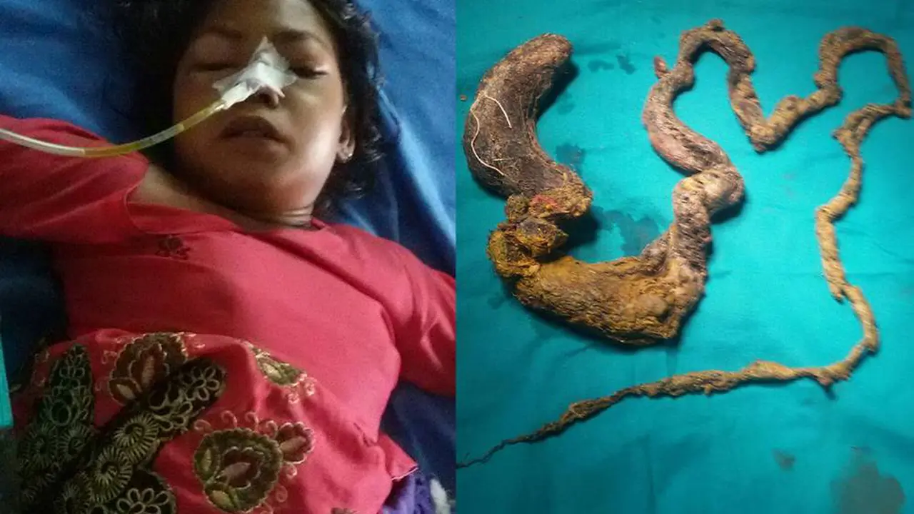 Dokter Angkat 150 Cm Rambut di Perut Remaja Ini