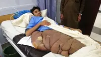 Seorang remaja di Pakistan hanya bisa berbaring di tempat tidur karena tumor seberat 20 kilogram di kakinya. Saking besarnya, tumor tersebut tampak seperti menelan paha dan pinggulnya. (Doc: StoryTrender)