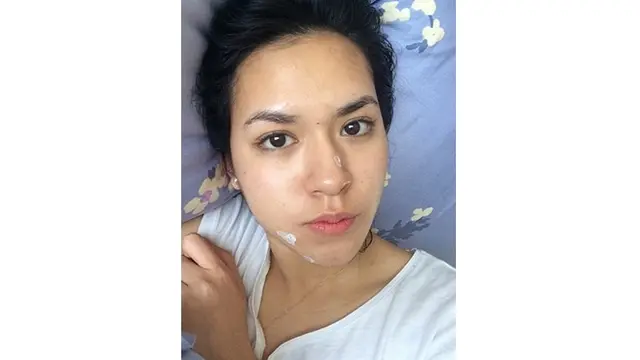 6 Seleb Ini Pernah Unggah Foto saat Wajah Berjerawat, Akui Tak Malu