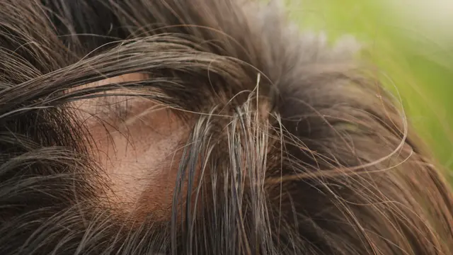 Ilustrasi Alopecia Areata