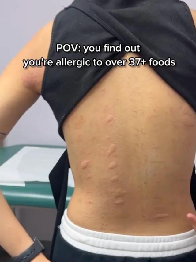 Kisah Wanita dengan 37 Alergi