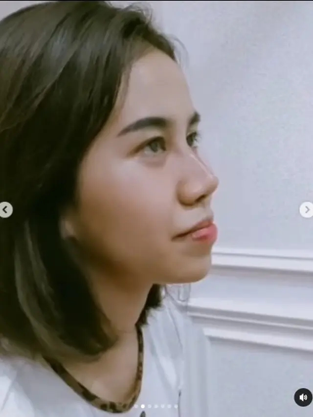 8 Potret Perubahan Wajah Mayang Usai Operasi Hidung, Sudah Lepas Perban