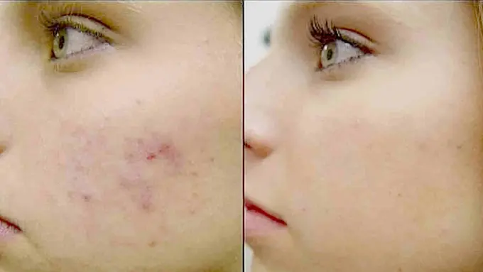 Buat Sendiri Ramuan untuk Hilangkan Bekas Jerawat pada Wajah