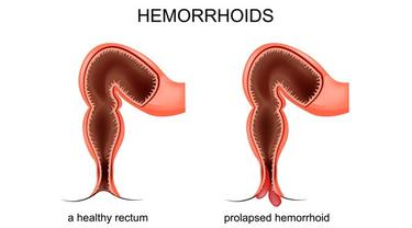 Hemoroid atau ambeien atau wasir
