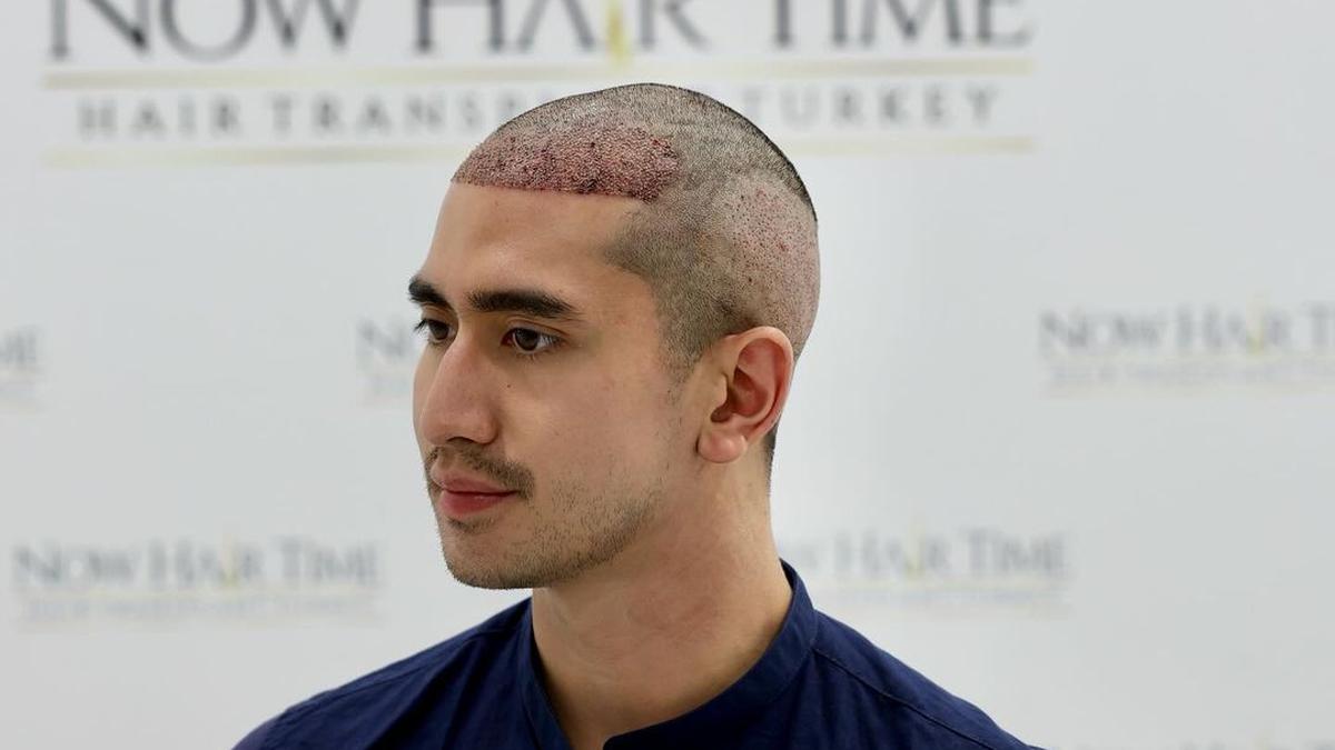 6 Potret Penampilan Baru Verrell Bramasta Usai Transplantasi Rambut di ...
