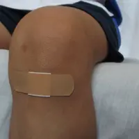 Ilustrasi luka. (dok. Pixabay/Novi Thedora