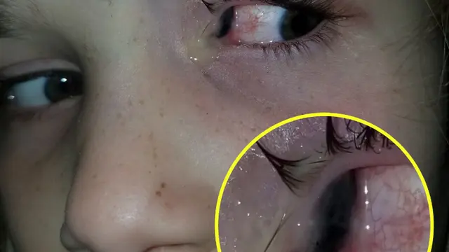 Mengaku Sakit Mata, Kumbang Hitam Keluar dari Mata Gadis Ini