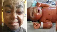 Seorang anak mengidap penyakit langka yang terjadi pada 1 banding 600.000 anak di dunia. Selama tiga hari ia tidak bisa menutup mata. (express.co.uk)