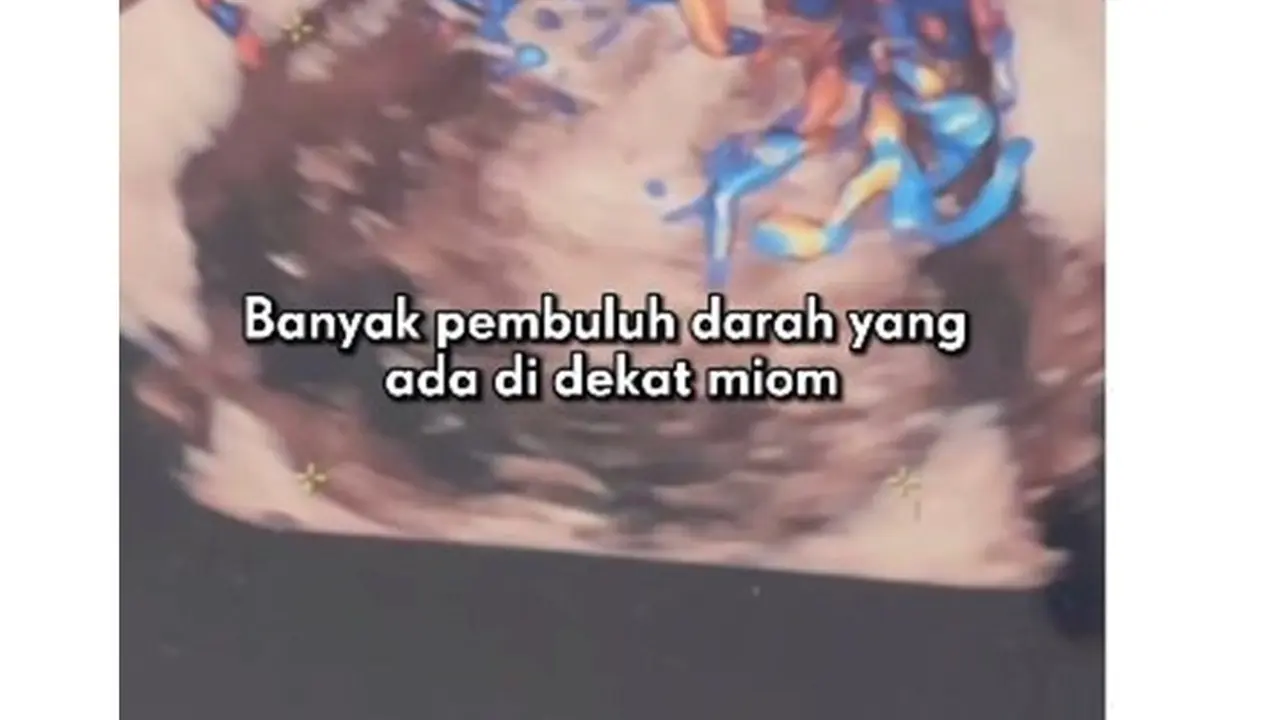 12 Potret Kondisi Alice Norin Usai Divonis Kanker Sarkoma, Terpaksa Menopause Dini