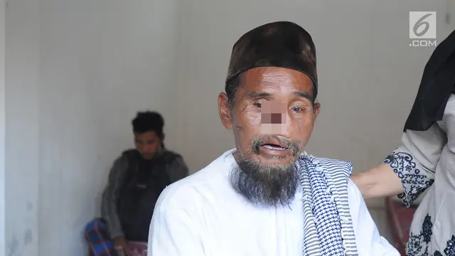 Viral Bermobil, Satpol PP Amankan Pengemis Tanpa Hidung di Bogor