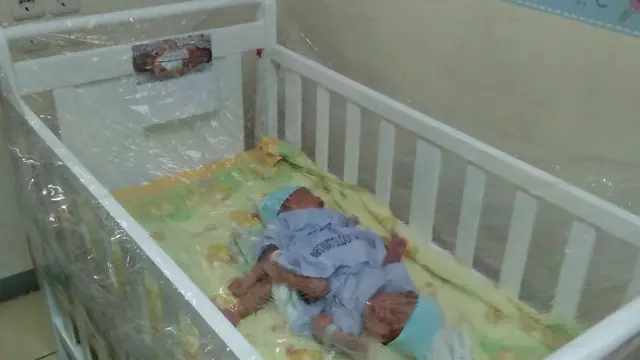 Bayi Kembar Siam Dempet