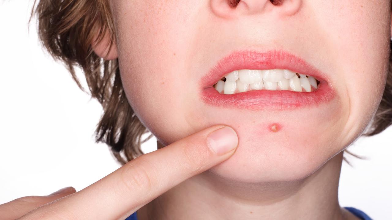 8 Makanan Bagi si Pemiliki Kulit Berjerawat