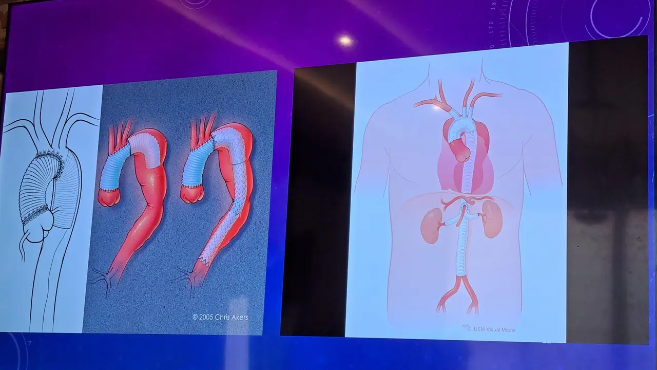 Mengenal Gangguan Pembuluh Darah Aorta, Berbahaya Bila Tidak Ditangani dengan Cepat