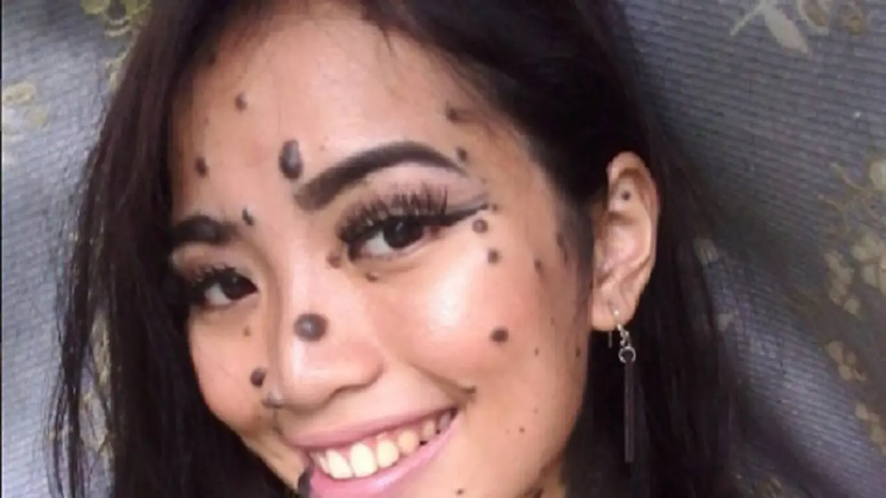Tahi Lalat Seluruh Tubuh, Wanita Ini Dibuli Ikut Ajang Kecantikan